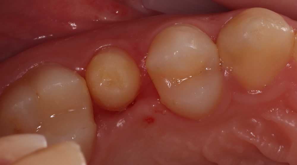 Autotransplantovany-vlastny-zub-ako-zaklad-pre-novu-korunku.jpg