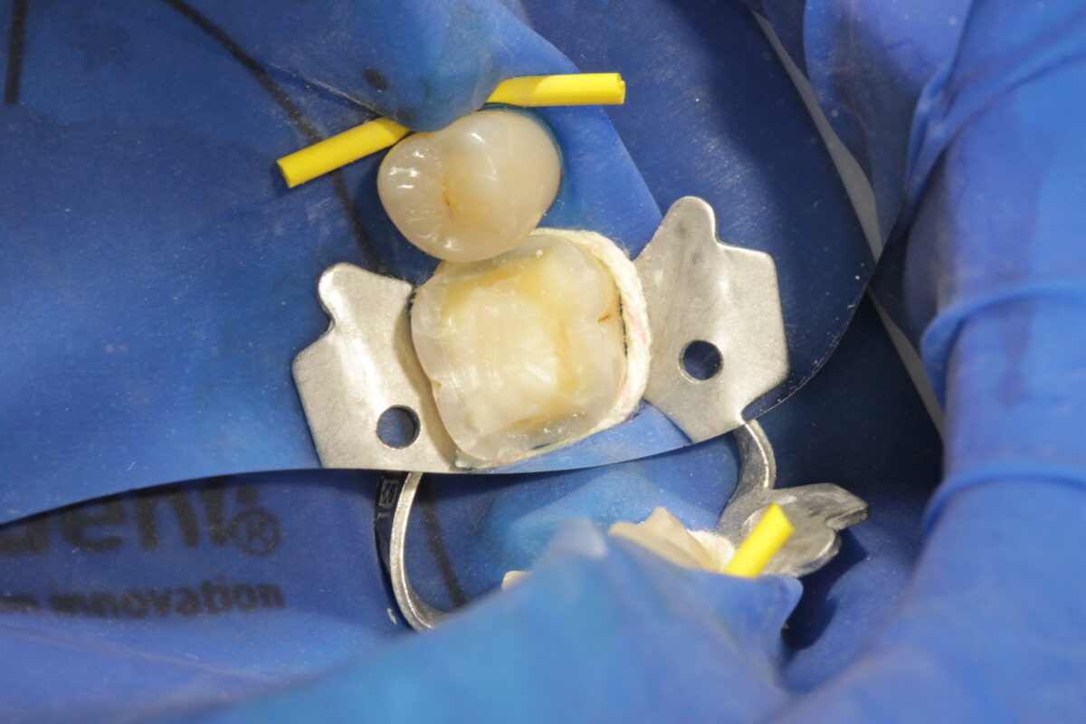 4.-zaplnenie-uzatvorenie-a-dobudovanie-zubu-priprava-na-polokorunku-1200x800.jpg